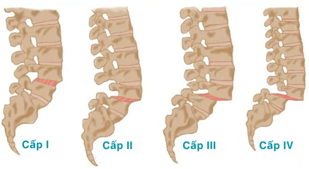 các cấp độ trượt cột sống l5