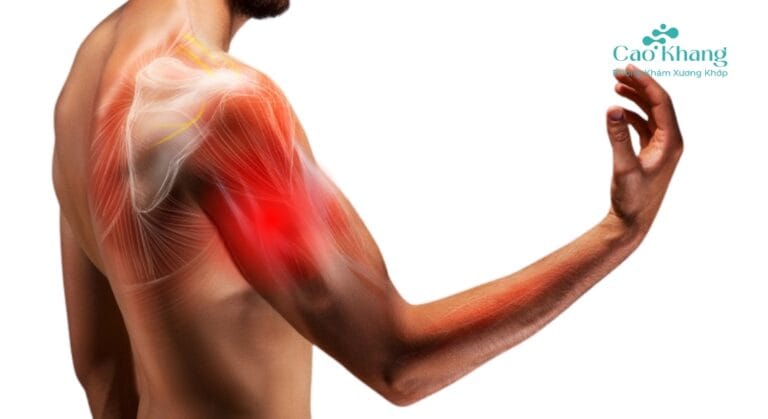căng cơ tay làm sao hết