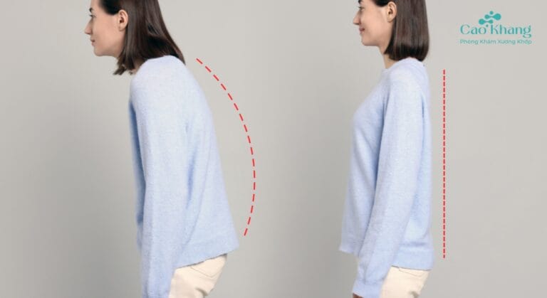 chữa gù lưng tại nhà