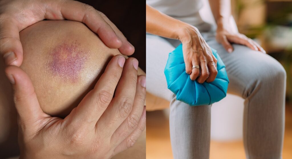 chườm lạnh bầm tím