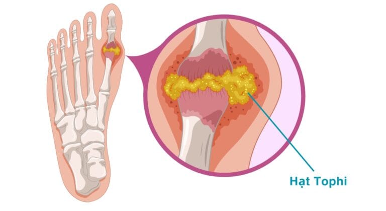 hạt tophi là gì?