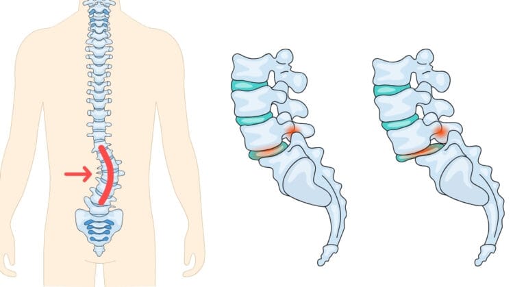 hình ảnh trượt đốt sống lưng