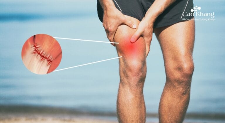làm gì khi bị căng cơ