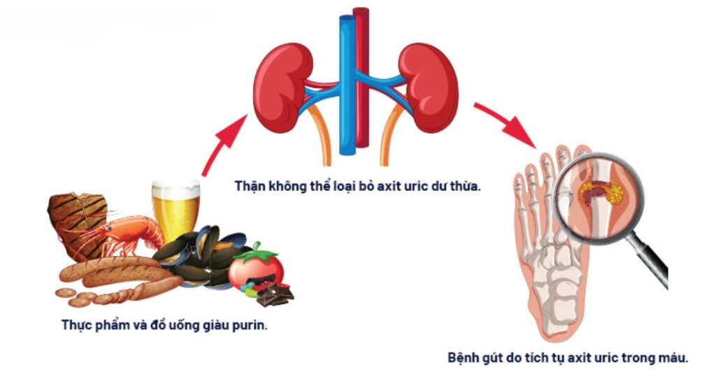 purine and acid uric
