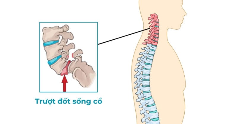 trượt đốt sống cổ