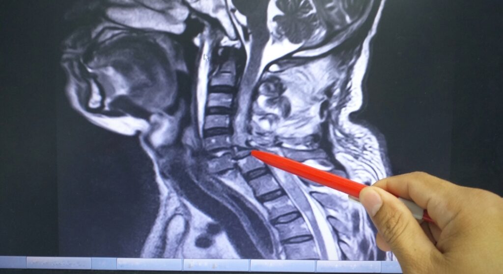 trượt đốt sống cổ MRI