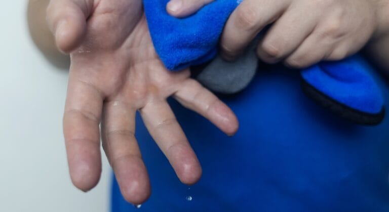 bệnh phong thấp ra mồ hôi tay chân