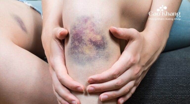 cách trị vết bầm tím nhanh nhất