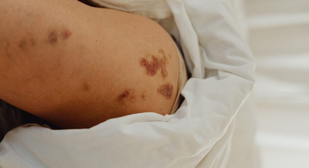 châm cứu bị bầm tím