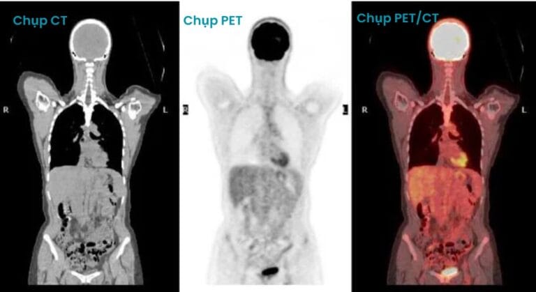 chụp PET/CT là gì?