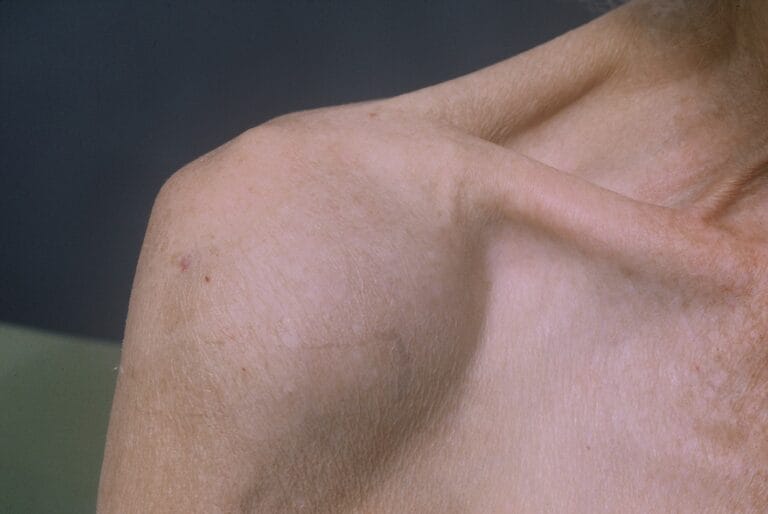 dấu hiệu tràn dịch khớp vai