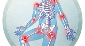 đau nhức xương khớp toàn thân