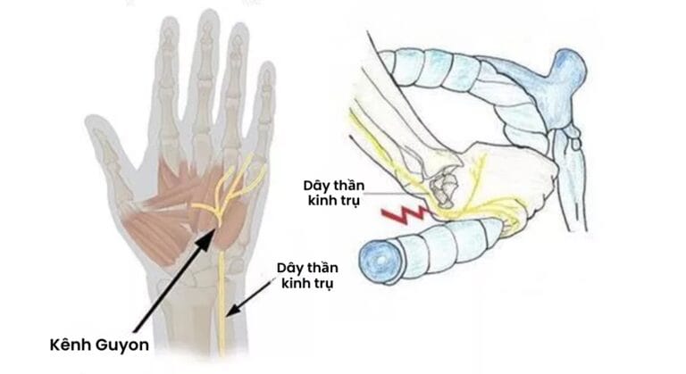 hội chứng kênh Guyon