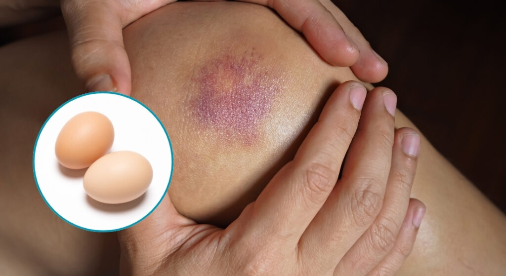 lăn trứng gà cho vết mầ tím