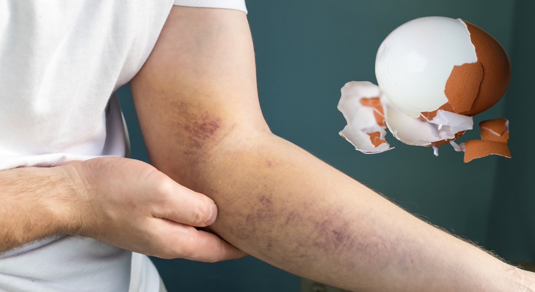 lăn trứng gà giảm bầm tím