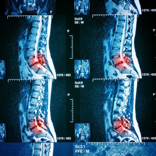 mri cột sống thắt lưng