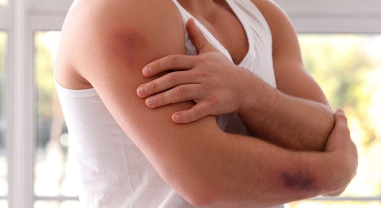 người dễ bị bầm tím