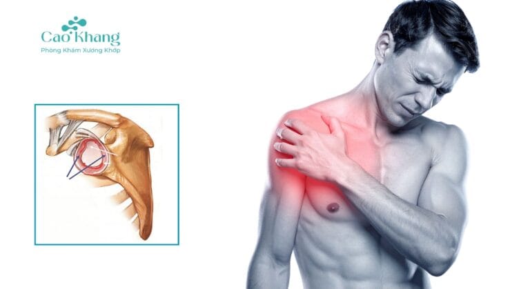 rách sụn viền khớp vai