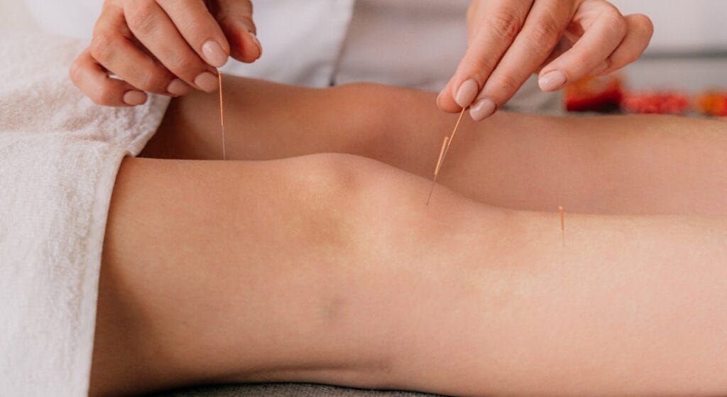 tác dụng phụ của châm cứu