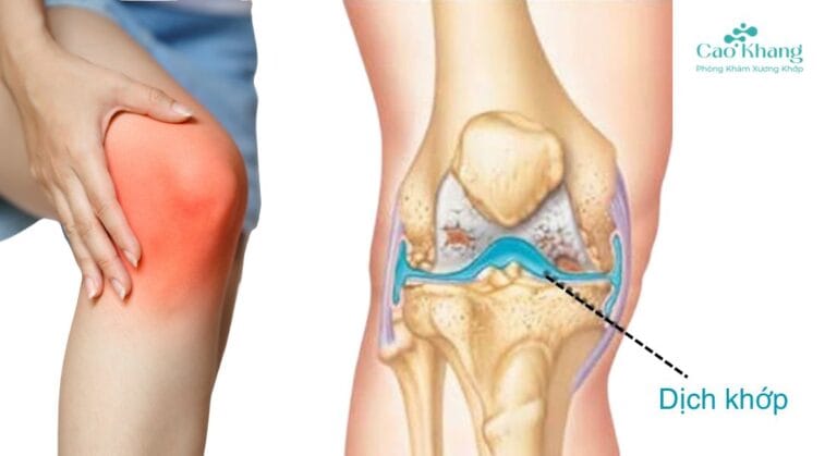 tràn dịch khớp gối