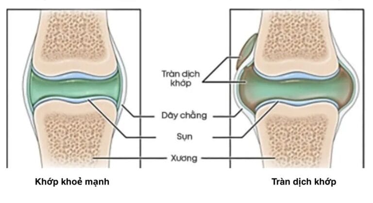 tràn dịch khớp gối