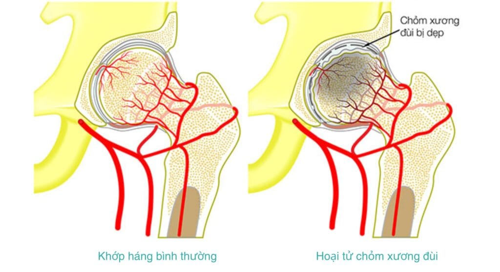 Hoại tử chỏm xương đùi