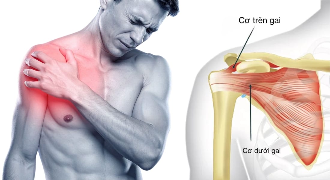 Viêm gân cơ trên gai vai phải