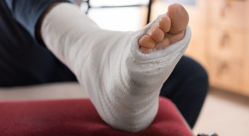 bị rạn xương có cần bó bột không