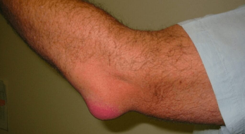 biến chứng tràn dịch khớp khuỷu tay