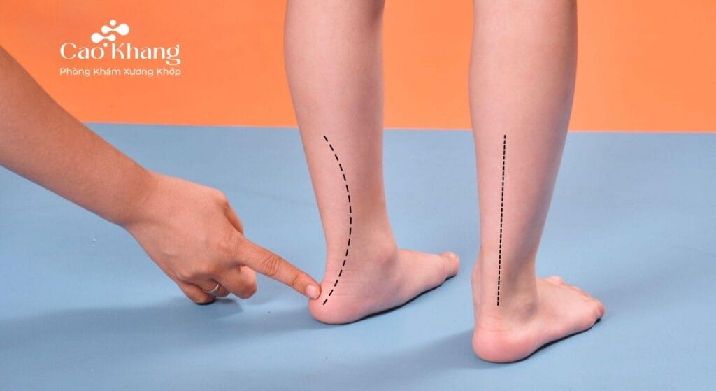 cách chữa bàn chân bẹt