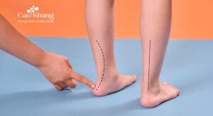 cách chữa bàn chân bẹt