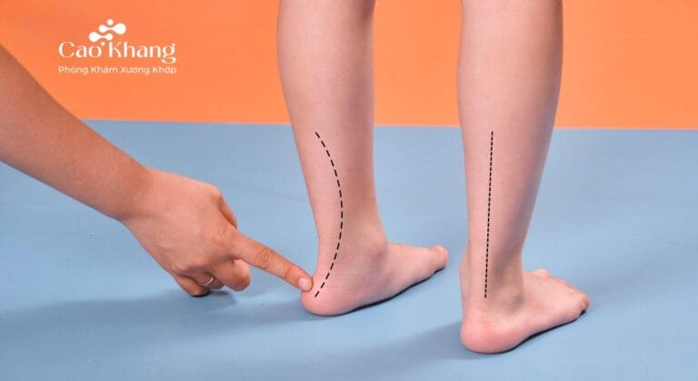 cách chữa bàn chân bẹt