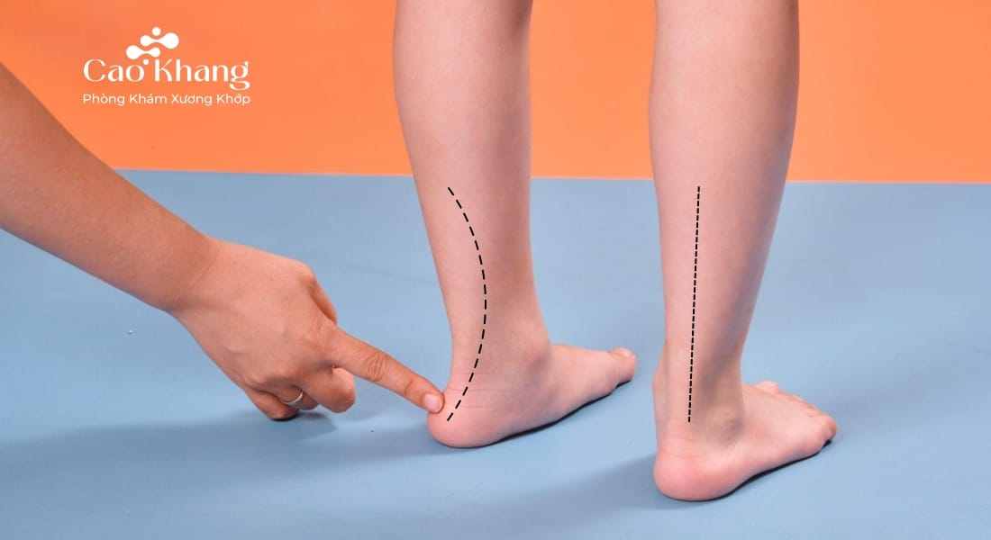 cách chữa bàn chân bẹt