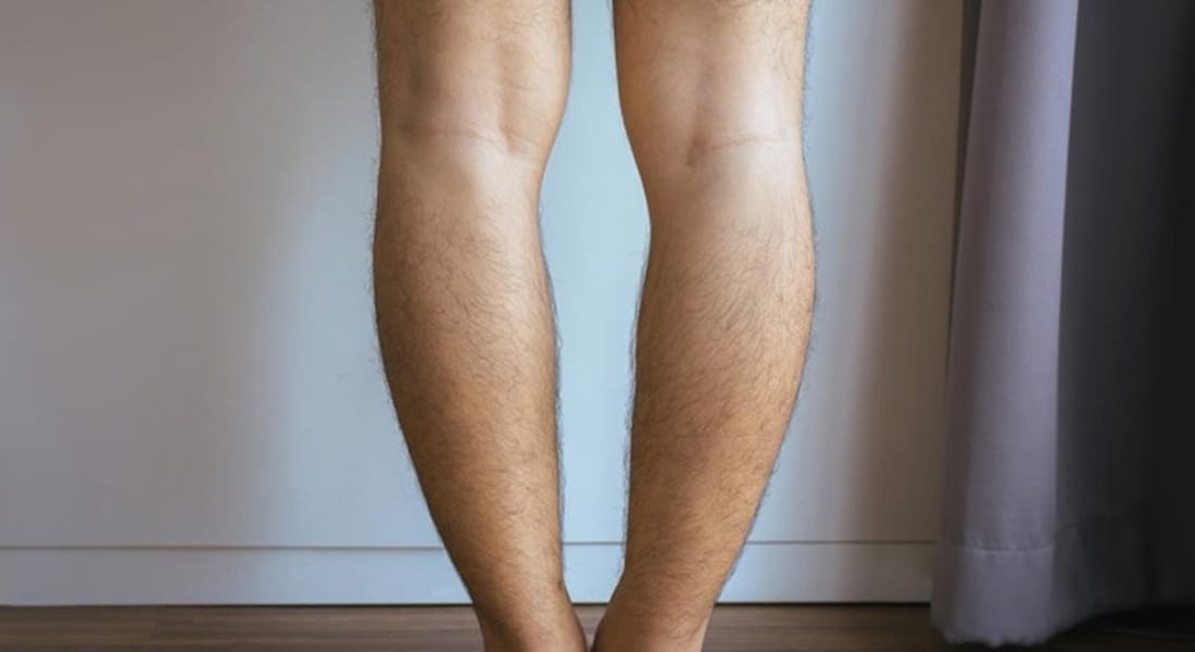 cách điều trị chân vòng kiềng