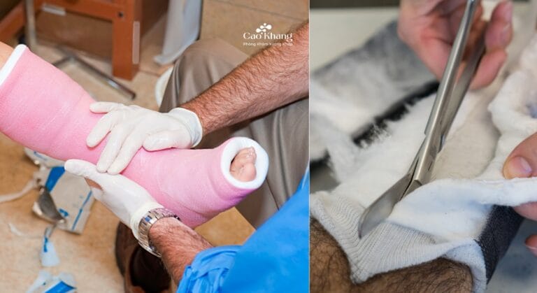 cách tự tháo bó bột tại nhà