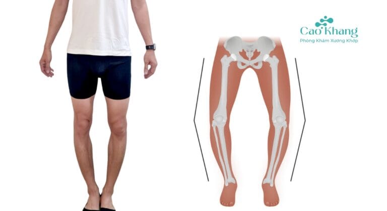 chân vòng kiềng là gì