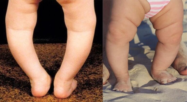 chân vòng kiềng ở trẻ em