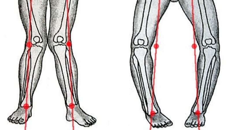 chân vòng kiềng ở trẻ