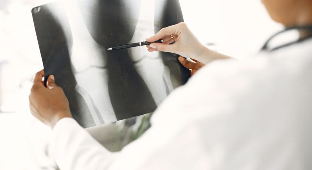 chụp x quang bị nứt xương