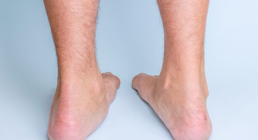 đau bàn chân bẹt (1)
