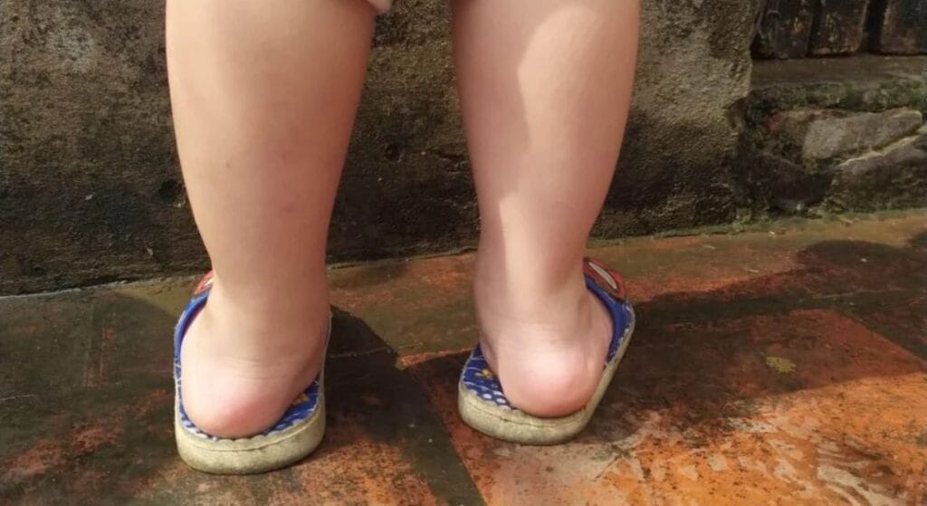 đau bàn chân bẹt ảnh hưởng dáng đi