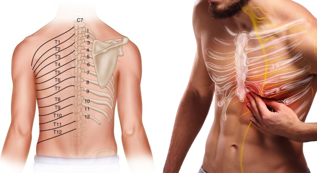 đau dây thần kinh liên sườn