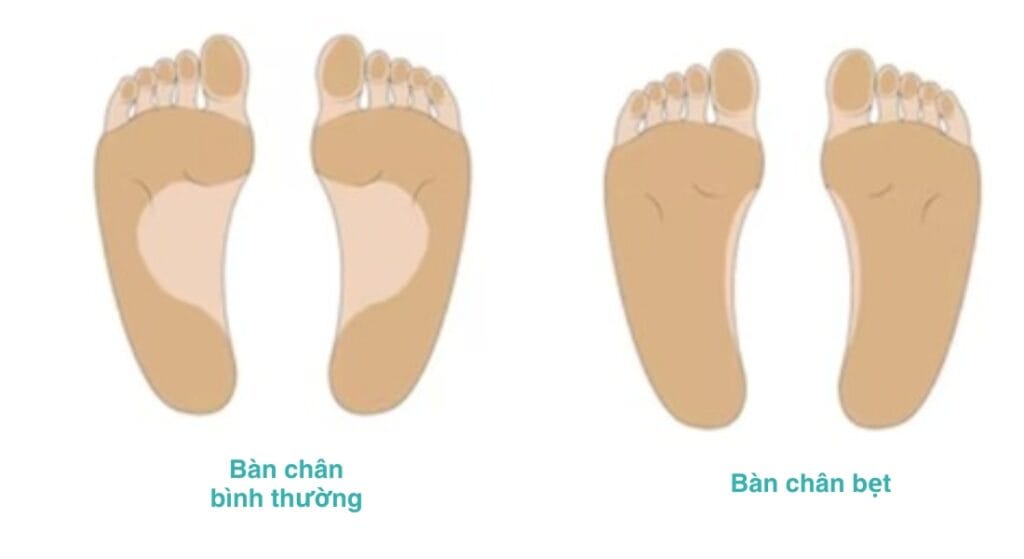dấu hiệu bàn chân bẹt ở trẻ em
