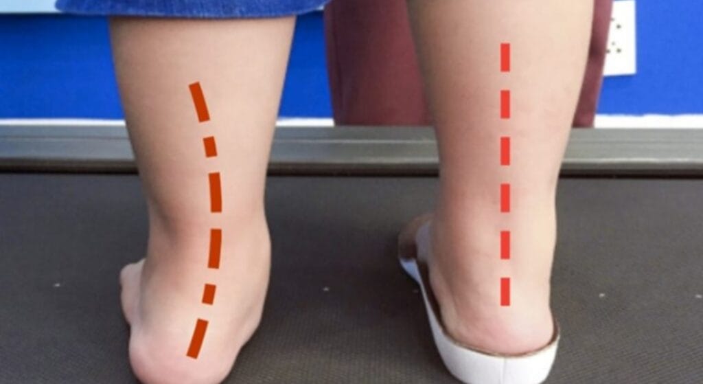 hình ảnh bàn chân bẹt