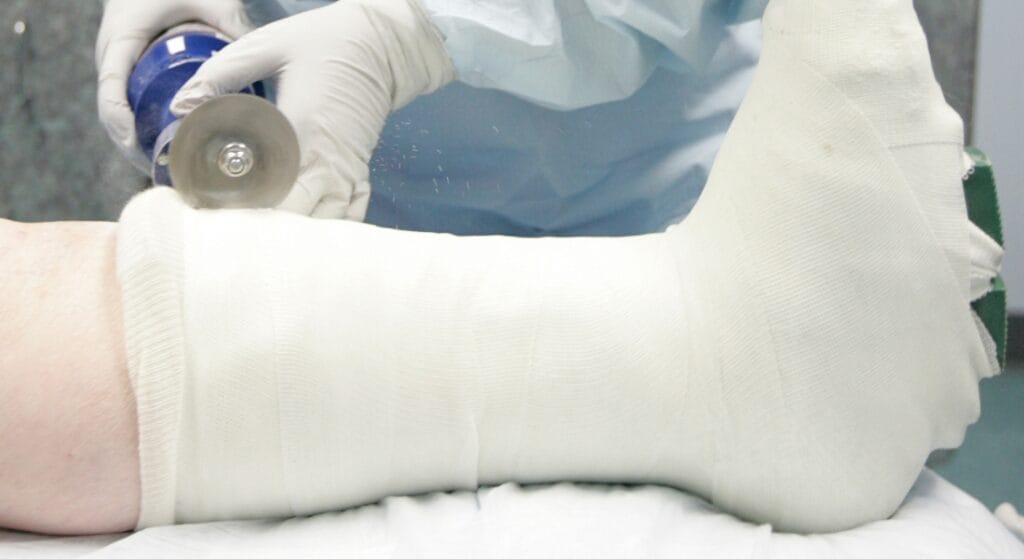 hình ảnh tháo bó bột tại cơ sở y tế