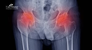 hoại tử chỏm xương đùi