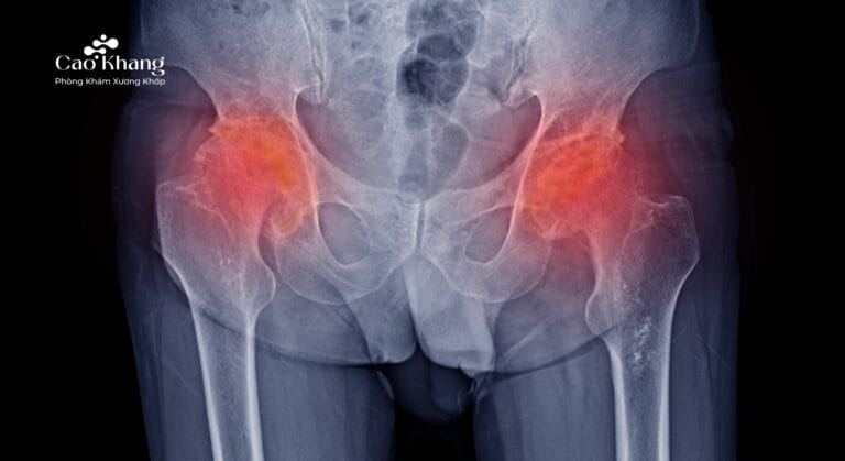 hoại tử chỏm xương đùi