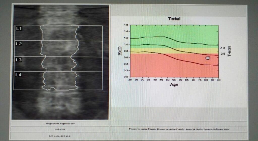 kết quả đo loãng xương