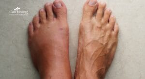 mu bàn chân bị sưng phù