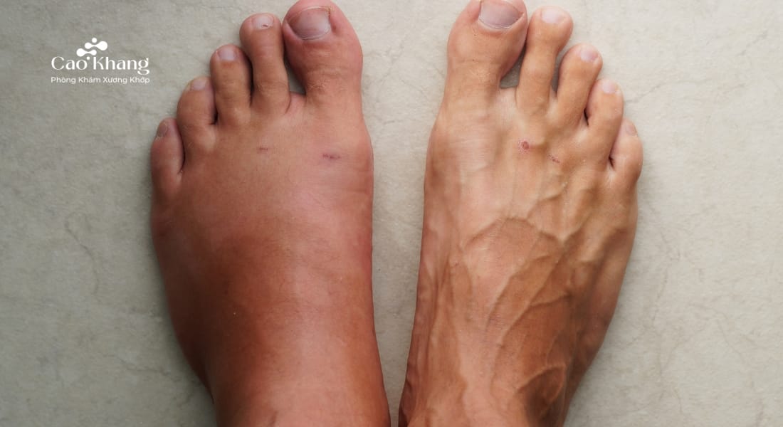 mu bàn chân bị sưng phù